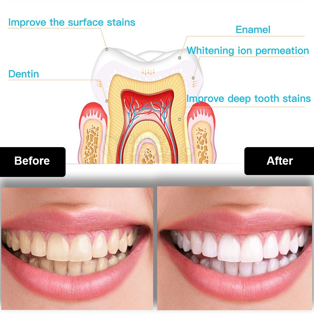 Dental Teeth Whitening Kit Min - огляд і ціна Teeth Whitening Pens