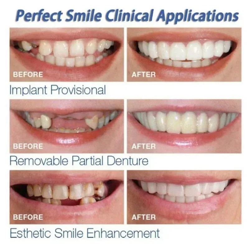 Snap-on Veneer Teeth Kit Adjus - огляд і ціна Teeth Whitening Kit