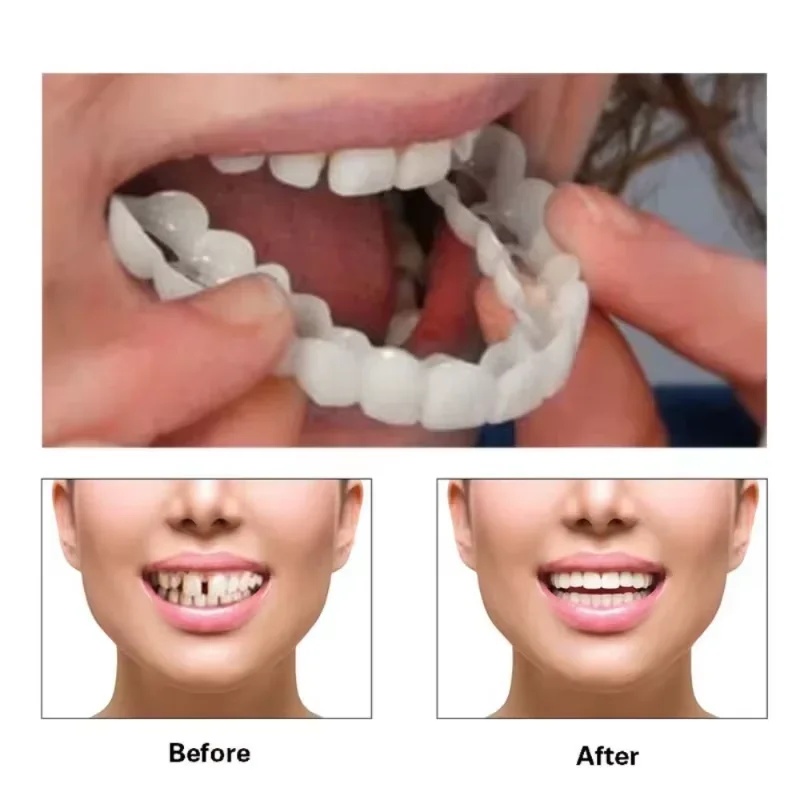 Snap-on Veneer Teeth Kit Adjus - огляд і ціна Teeth Whitening Kit